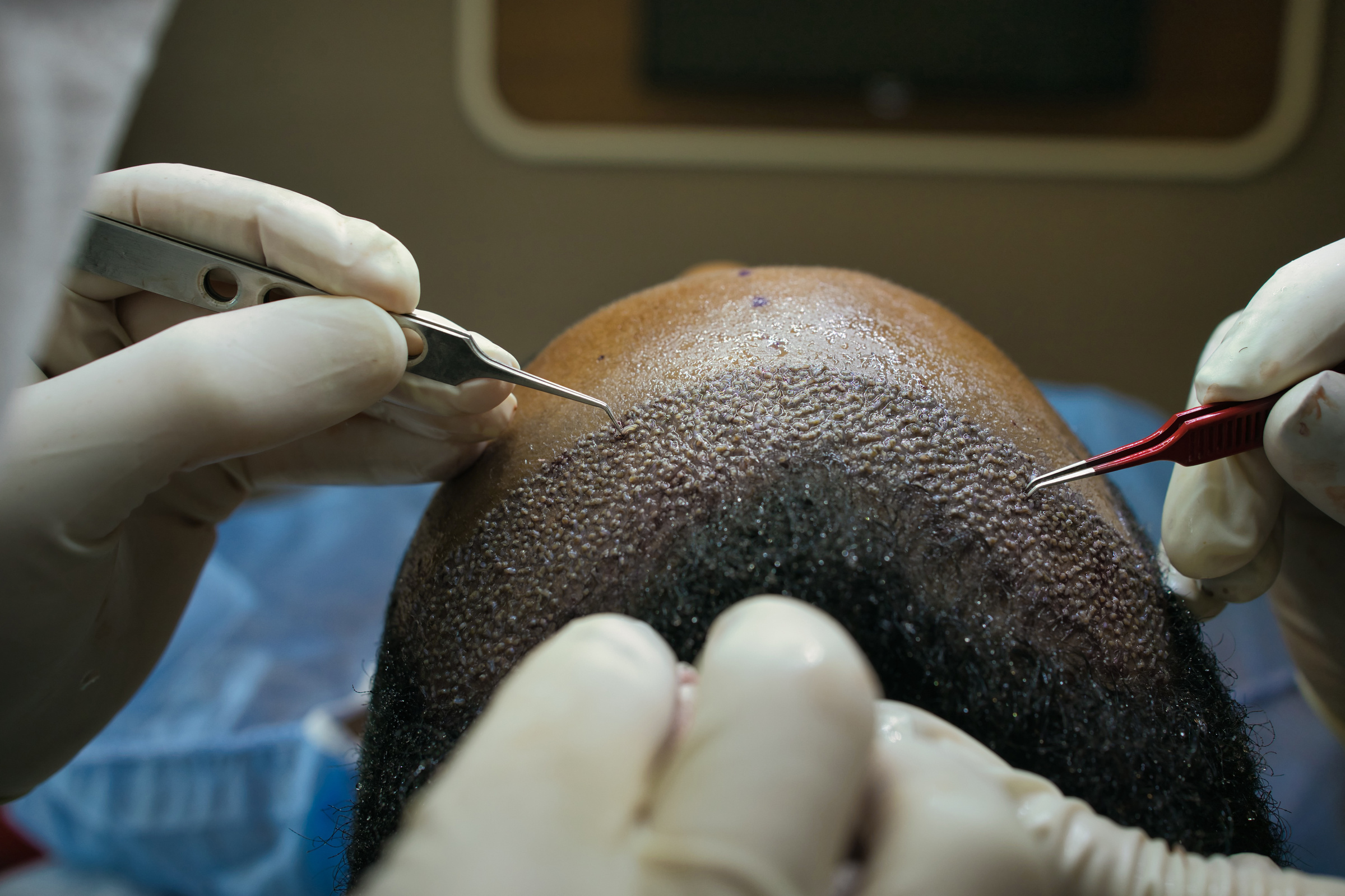 Hair Transplant