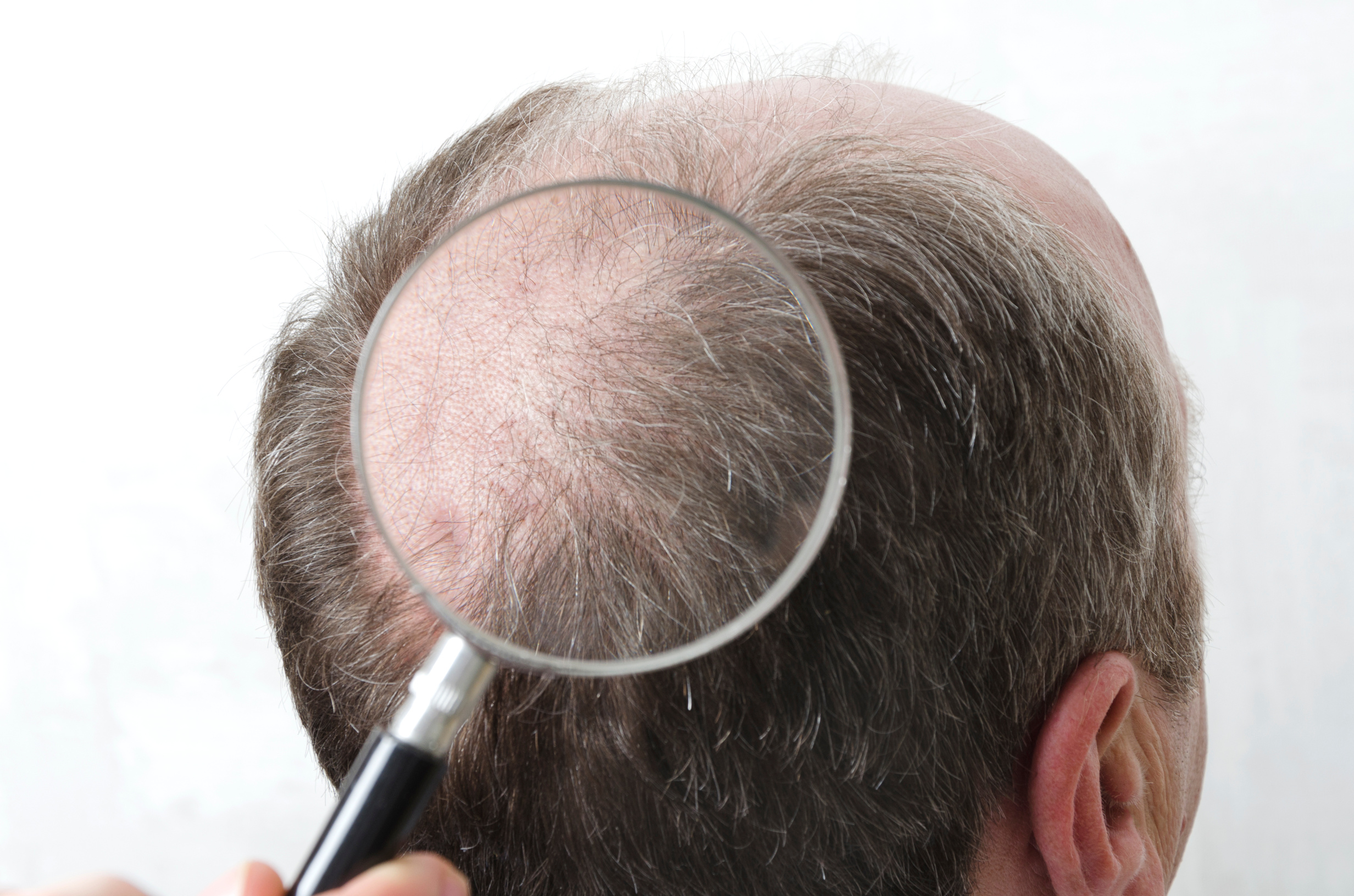 Concept of hair transplantation. Closeup of magnifying glass, exploring man`s back of head where is no hair