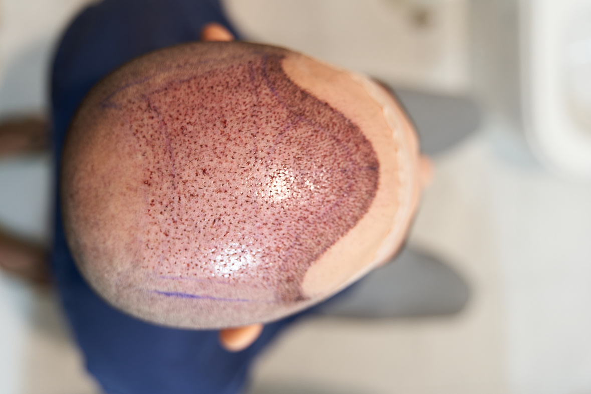 Top view of scalp after hair transplant surgery